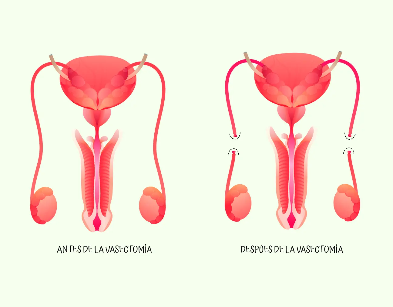 anticonceptivos quirurgicos - Cuáles son los métodos anticonceptivos quirúrgicos