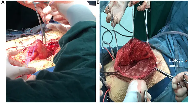 Fístula Enterocutánea: Una Complicación Compleja con Enfoque en el Manejo Nutricional - Cuáles son los principios en el cuidado de piel cuando hay fístulas enterocutáneas fistula enterocutanea - Cuáles son los principios en el cuidado de piel cuando hay fístulas enterocutáneas