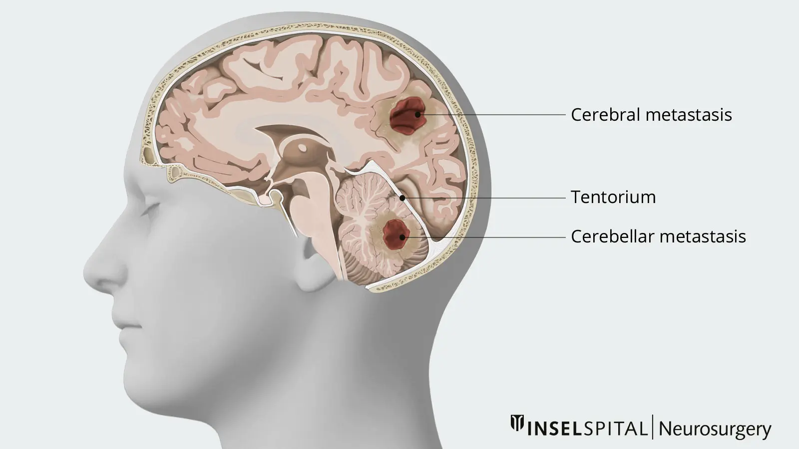 Metástasis Cerebral: Síntomas, Tratamiento y Todo Lo Que Necesitas Saber - Cuáles son los síntomas de la metástasis metastasis cerebral - Cuáles son los síntomas de la metástasis