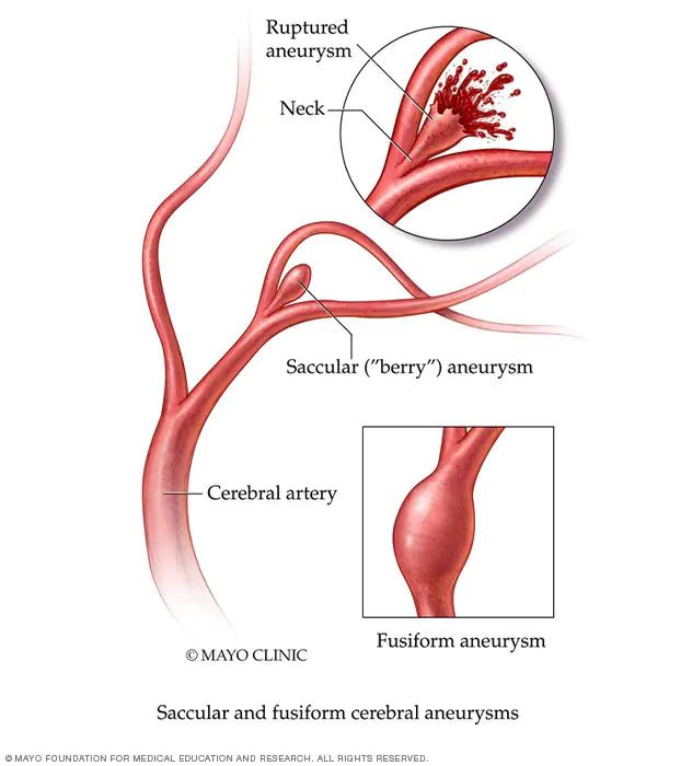 Aneurisma Cerebral: Causas, Síntomas, Diagnóstico y Tratamiento - Cuáles son los síntomas del aneurisma que es aneurisma cerebral - Cuáles son los síntomas del aneurisma
