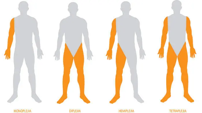 Hemiplejía Espástica: Causas, Síntomas, Tratamiento y Más - Cuáles son los tipos de hemiplejia hemiplejia espastica - Cuáles son los tipos de hemiplejia