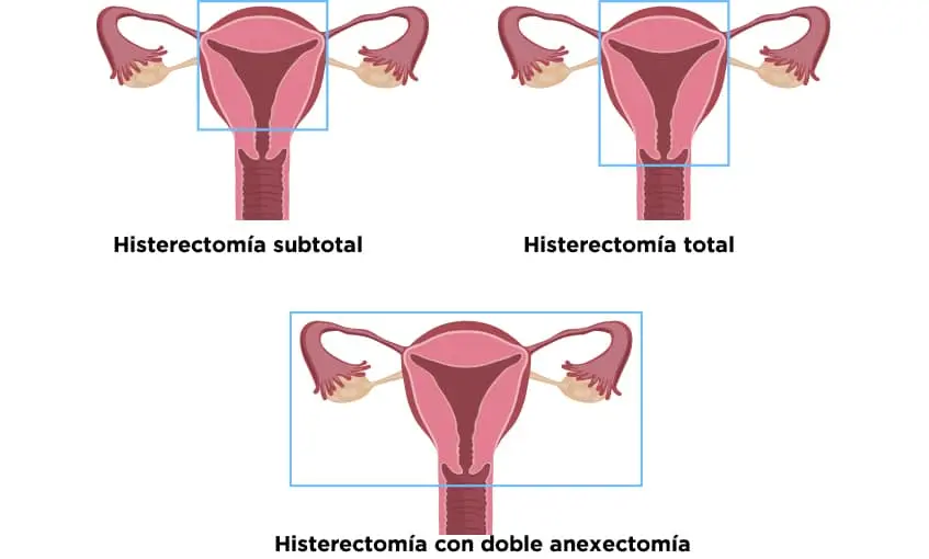 Tipos de Histerectomía: Una Guía Completa - Cuáles son los tipos de histerectomía anexohisterectomia - Cuáles son los tipos de histerectomía