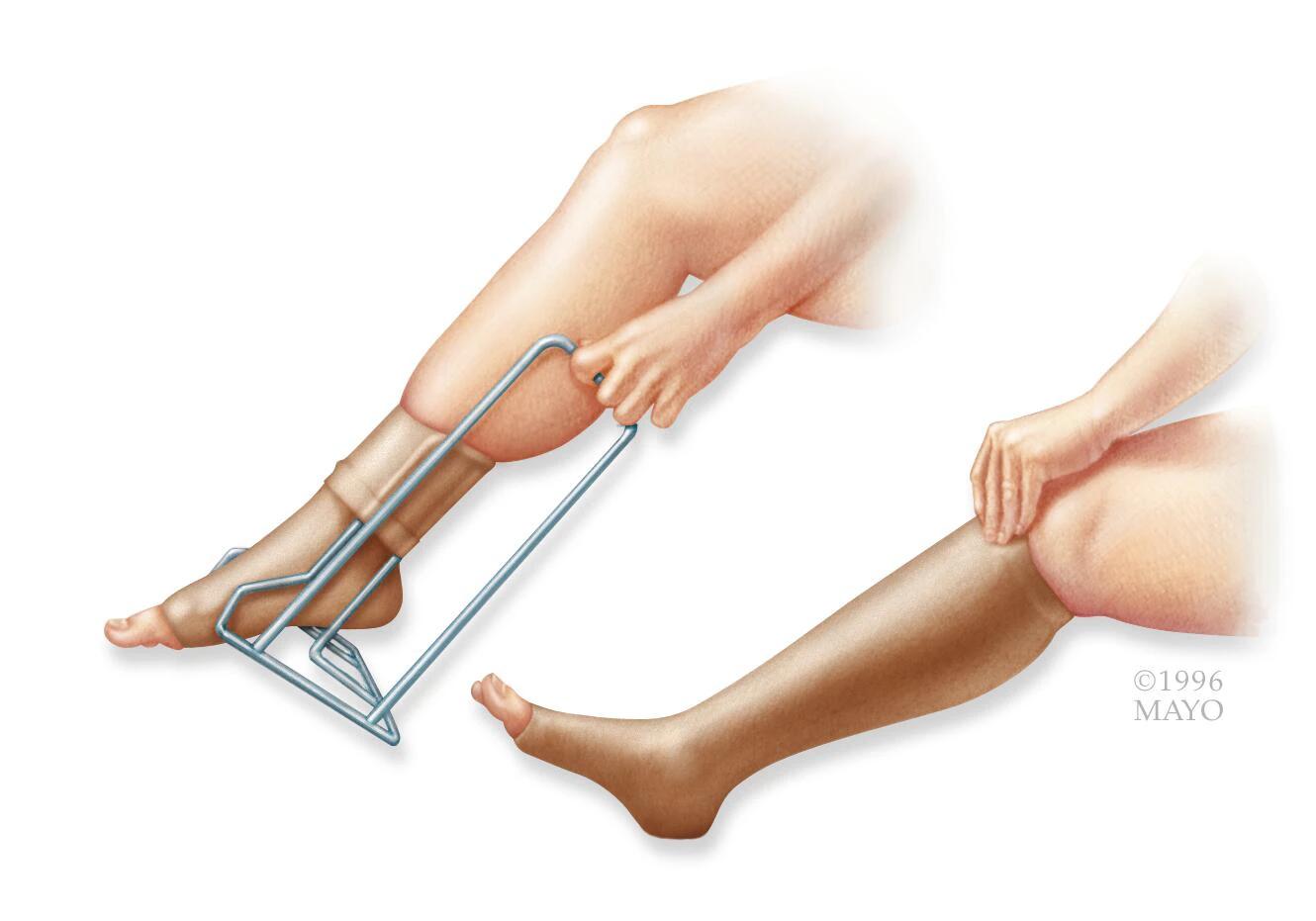 Tromboflebitis: cuándo anticoagular y qué opciones de tratamiento existen - Cuándo anticoagular una tromboflebitis tromboflebitis tratamiento - Cuándo anticoagular una tromboflebitis