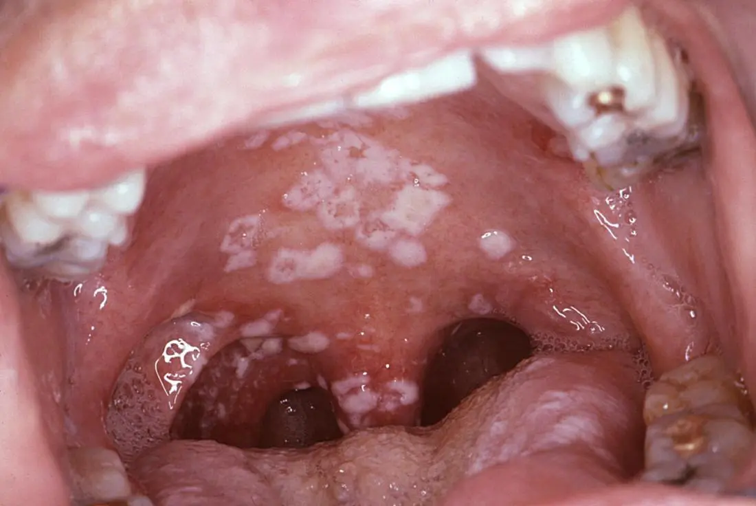 Aftas en la boca por VIH: Síntomas, etapas y tratamiento - Cuándo aparecen las llagas en la boca por VIH aftas por vih - Cuándo aparecen las llagas en la boca por VIH
