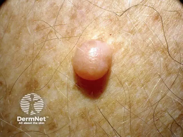 Neurofibroma: Causas, Síntomas y Tratamiento - Cuándo aparecen los neurofibromas neurofibroma - Cuándo aparecen los neurofibromas