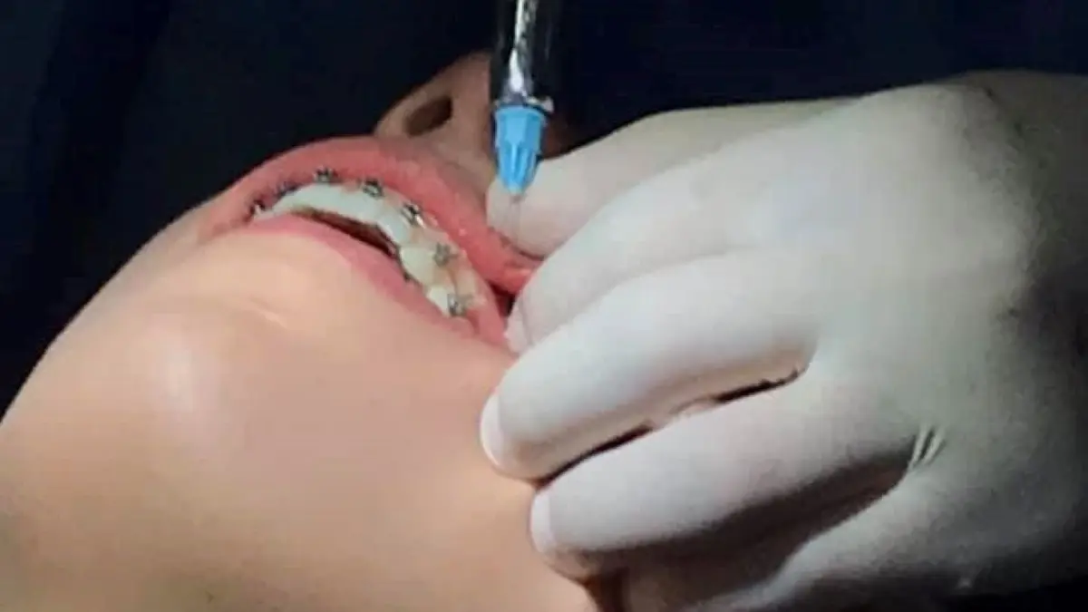 Facultad de Odontología de la UBA: Tratamiento de Conducto - Cuándo atiende la facultad de odontología facultad de odontologia tratamiento de conducto - Cuándo atiende la facultad de odontología