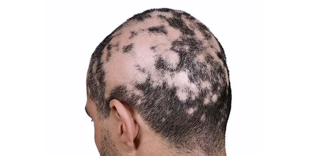alopecia en hombres - Cuándo comienza la alopecia en hombres