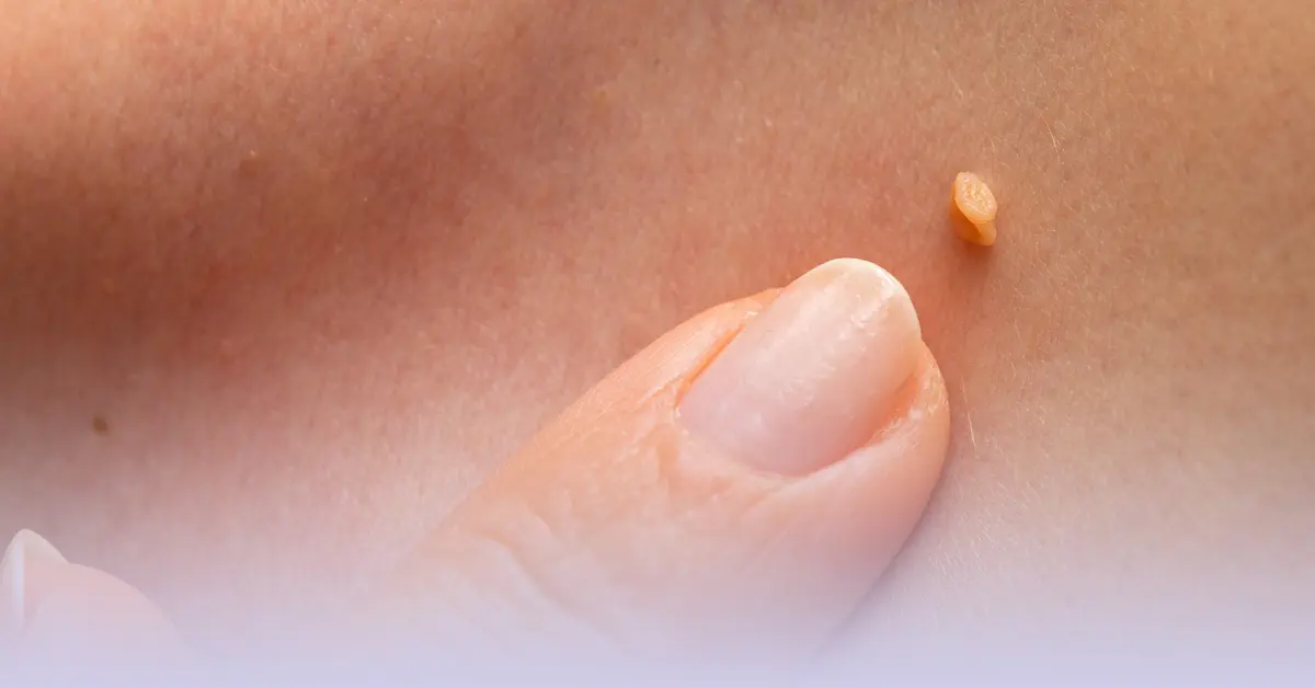 Verrugas en la Vulva: Qué son, Causas, Síntomas y Tratamiento - Cuándo debo preocuparme por una verruga verrugas en la vulva - Cuándo debo preocuparme por una verruga
