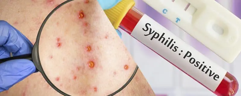 Cómo saber si te has curado de la sífilis: Guía completa - Cuándo deja de ser contagiosa la sífilis como saber si me cure de sifilis - Cuándo deja de ser contagiosa la sífilis