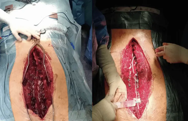 Cirugía de Escoliosis: Riesgos, Procedimientos y Recuperación - Cuándo es recomendable operarse de escoliosis cirugia escoliosis - Cuándo es recomendable operarse de escoliosis