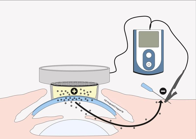 Iontoforesis en lesiones deportivas: ¿eficaz o sobrevalorada? - Cuándo hace efecto la iontoforesis iontoforesis - Cuándo hace efecto la iontoforesis