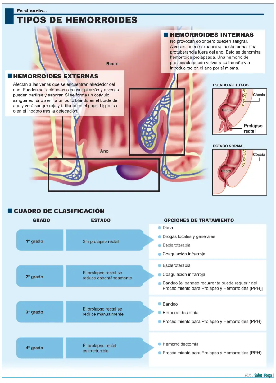 Consecuencias de las Hemorroides No Tratadas: Una Guía Completa - Cuándo hay que preocuparse por las hemorroides consecuencias de hemorroides no tratadas - Cuándo hay que preocuparse por las hemorroides