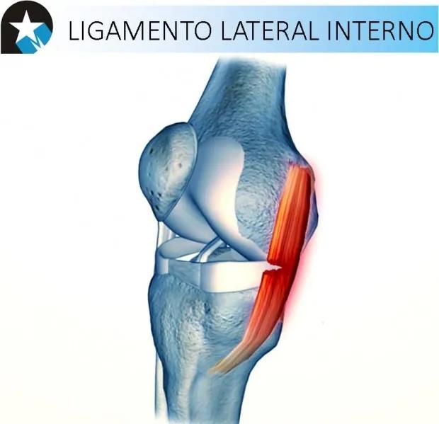 Rotura del Ligamento Lateral Interno: Tiempo de Recuperación y Consejos para la Rehabilitación - Cuando hay rotura de ligamentos se puede caminar rotura ligamento lateral interno tiempo de recuperacion - Cuando hay rotura de ligamentos se puede caminar