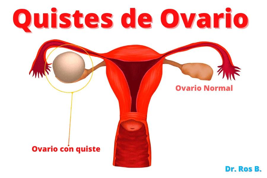 Quistes en los Ovarios y Fertilidad: ¿Qué Necesitas Saber? - Cuando la mujer tiene quistes en los ovarios, puede quedar embarazada que pasa si tengo quistes en los ovarios - Cuando la mujer tiene quistes en los ovarios, puede quedar embarazada