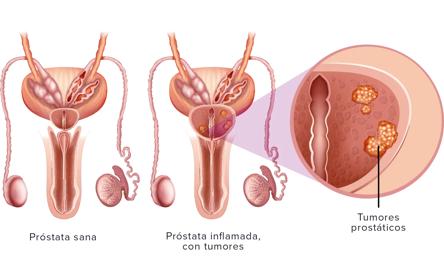 Relaciones sexuales y la próstata: ¿Cómo ayudan a desinflamarla? - Cuando la próstata está inflamada se puede tener relaciones tener relaciones ayuda a desinflamar la prostata - Cuando la próstata está inflamada se puede tener relaciones