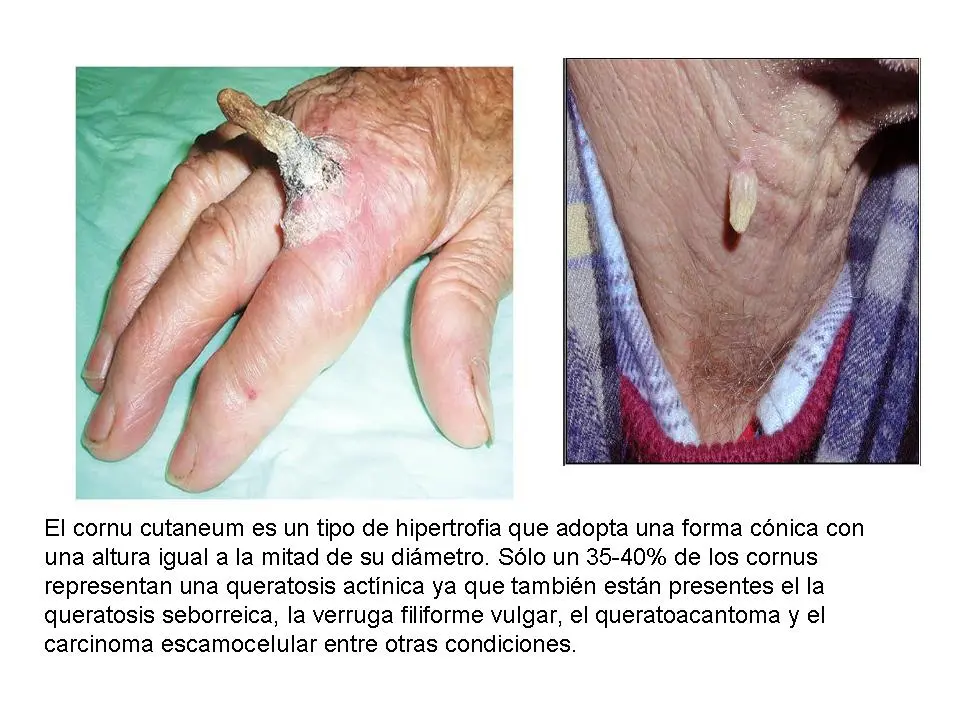 Queratosis Actínica Hipertrófica: Qué Es, Causas, Síntomas y Tratamiento - Cuándo la queratosis es peligrosa queratosis actinica hipertrofica - Cuándo la queratosis es peligrosa