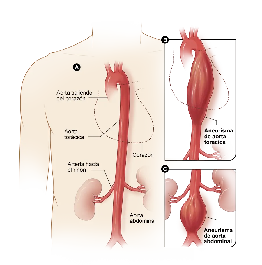 Aneurisma de Aorta Torácica: Diagnóstico, Tratamiento y Riesgos - Cuándo operar un aneurisma de aorta torácica aneurisma de aorta toracica - Cuándo operar un aneurisma de aorta torácica
