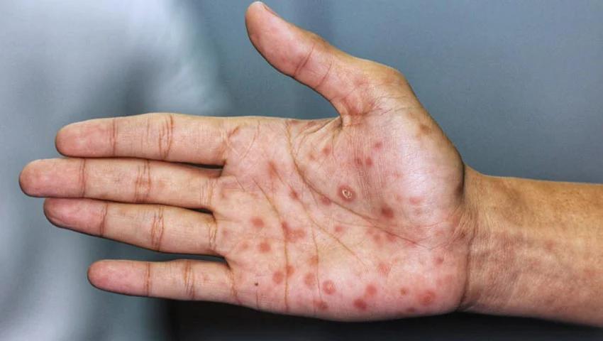 Cómo saber si te has curado de la sífilis: Guía completa - Cuándo se considera curada la sífilis como saber si me cure de sifilis - Cuándo se considera curada la sífilis