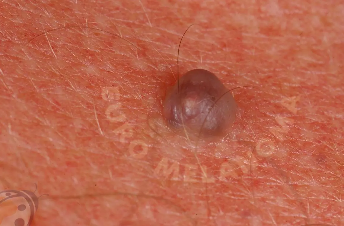 Hemangioma en Adultos: ¿Qué es, Causas, Síntomas y Tratamiento? - Cuándo se debe operar un hemangioma hemangioma en adultos - Cuándo se debe operar un hemangioma