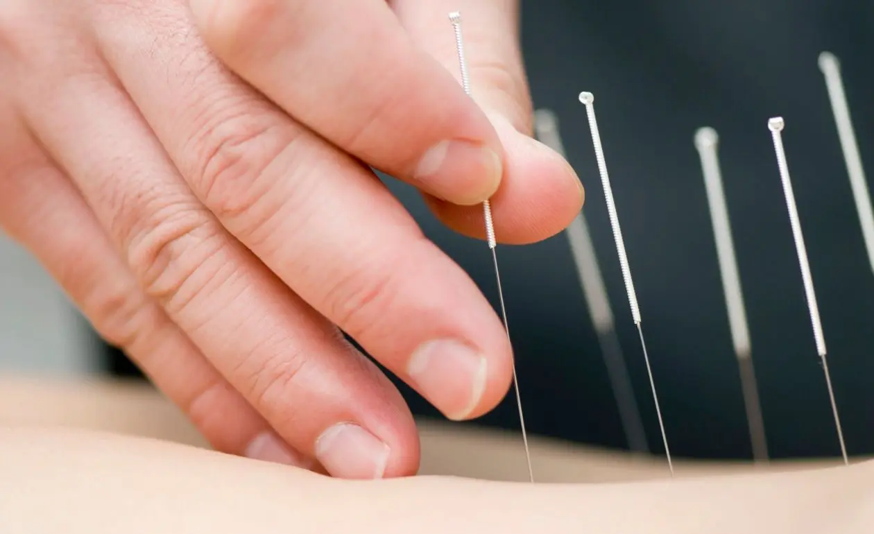Beneficios de la Acupuntura para el Sistema Nervioso: Una Mirada Científica - Cuándo se empieza a notar el efecto de la acupuntura beneficios de la acupuntura para el sistema nervioso - Cuándo se empieza a notar el efecto de la acupuntura