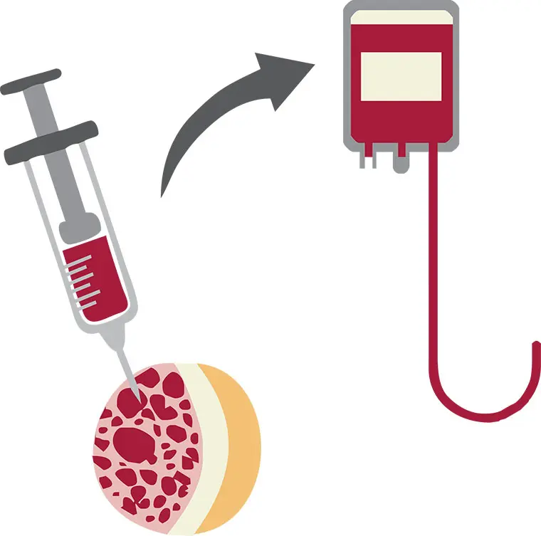 autotransplante de medula - Cuándo se hace un autotrasplante de médula