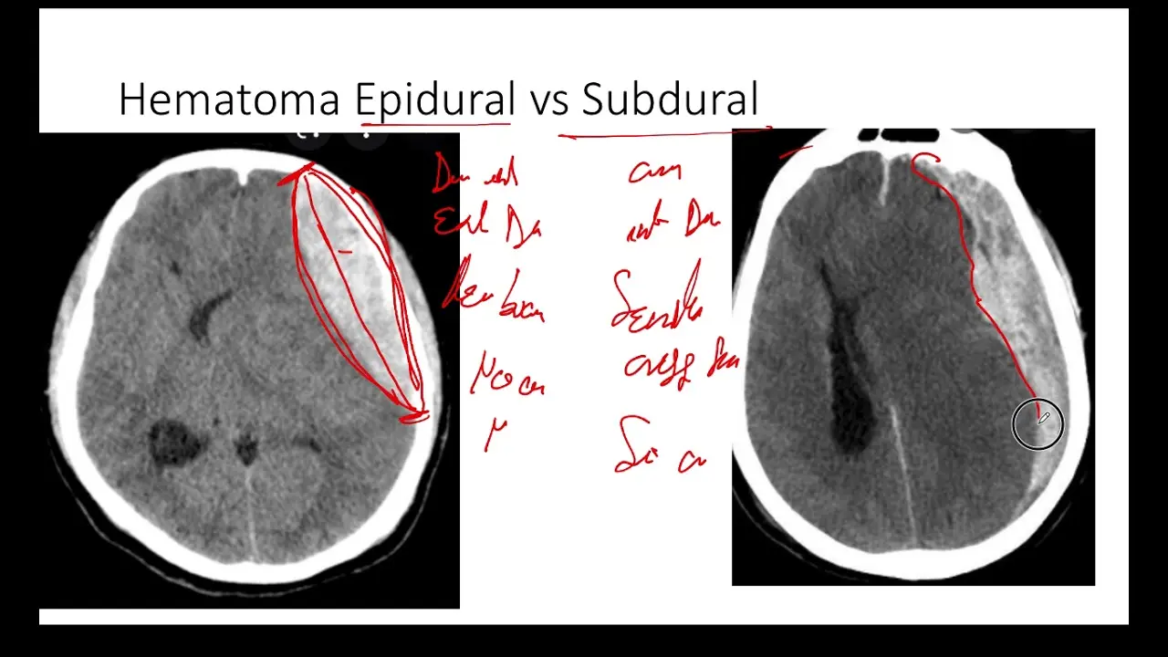 hematoma epidural y subdural - Cuándo se opera un hematoma epidural