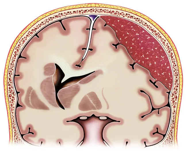 Hematomas subdurales: Causas, síntomas, diagnóstico y tratamiento - Cuándo se opera un hematoma subdural hematoma subdural - Cuándo se opera un hematoma subdural