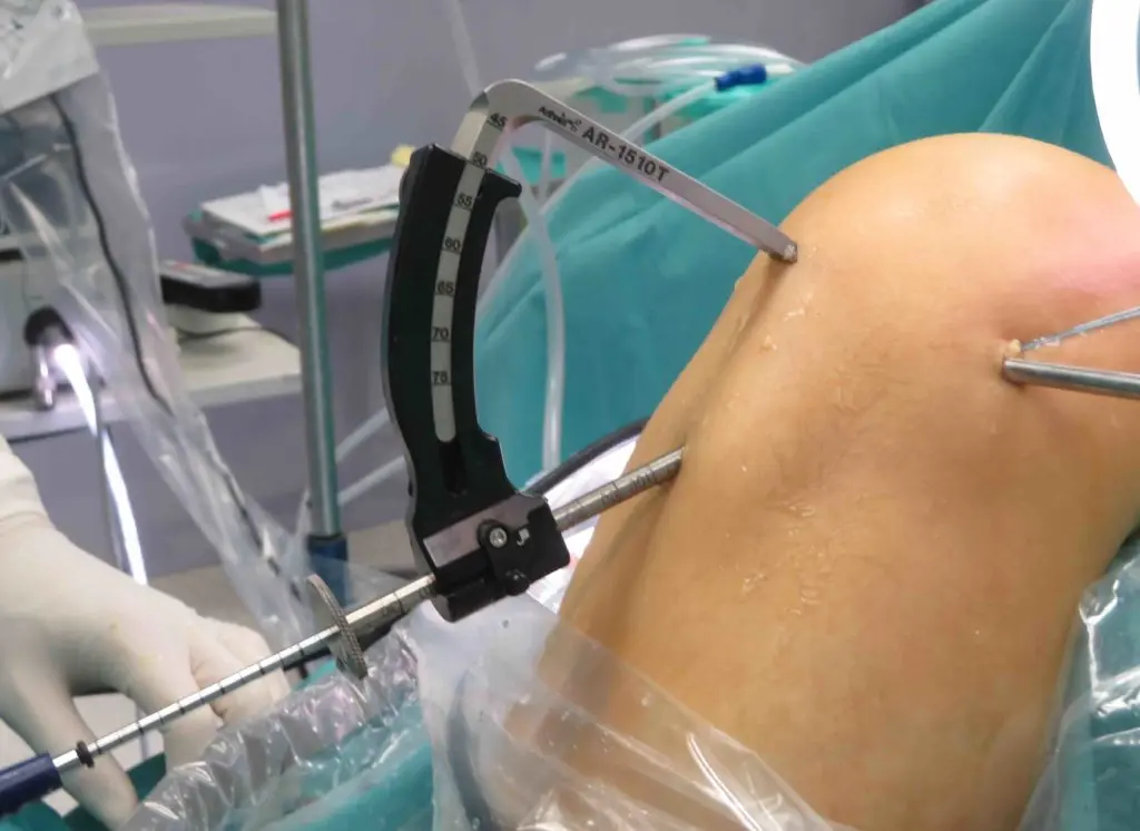 Cuándo se puede andar después de una operación de LCA: Guía completa para la recuperación - Cuándo se puede andar después de una operación de LCA operacion lca - Cuándo se puede andar después de una operación de LCA