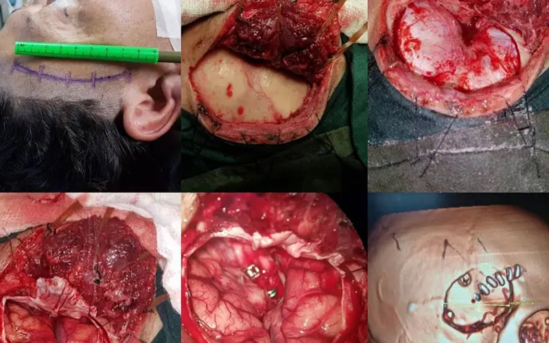 Aneurisma Cerebral: Cirugía y Recuperación - Cuántas horas dura una operación de aneurisma aneurisma cerebral cirugia - Cuántas horas dura una operación de aneurisma