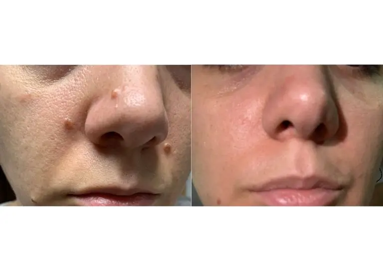 Extracción de Verrugas en la Cara: Costos, Métodos y Tipos - Cuánto cobran por quitar una verruga en la cara extraccion de verrugas en la cara - Cuánto cobran por quitar una verruga en la cara
