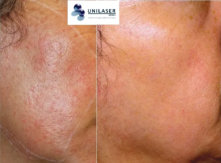 Extracción de Verrugas en la Cara: Costos, Métodos y Tipos - Cuánto cuesta quitar una verruga en la cara extraccion de verrugas en la cara - Cuánto cuesta quitar una verruga en la cara