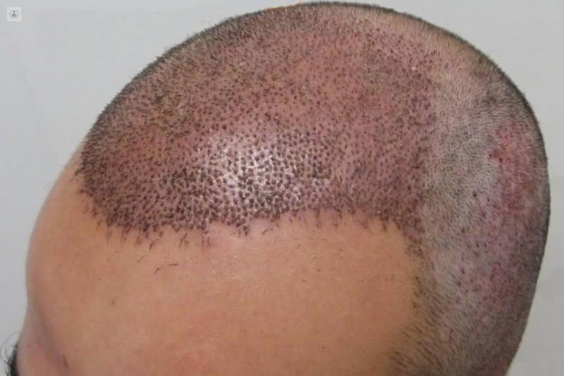 Precio de un trasplante capilar en España: Guía Completa 2024 - Cuánto cuesta un injerto de pelo trasplante de cabello - Cuánto cuesta un injerto de pelo