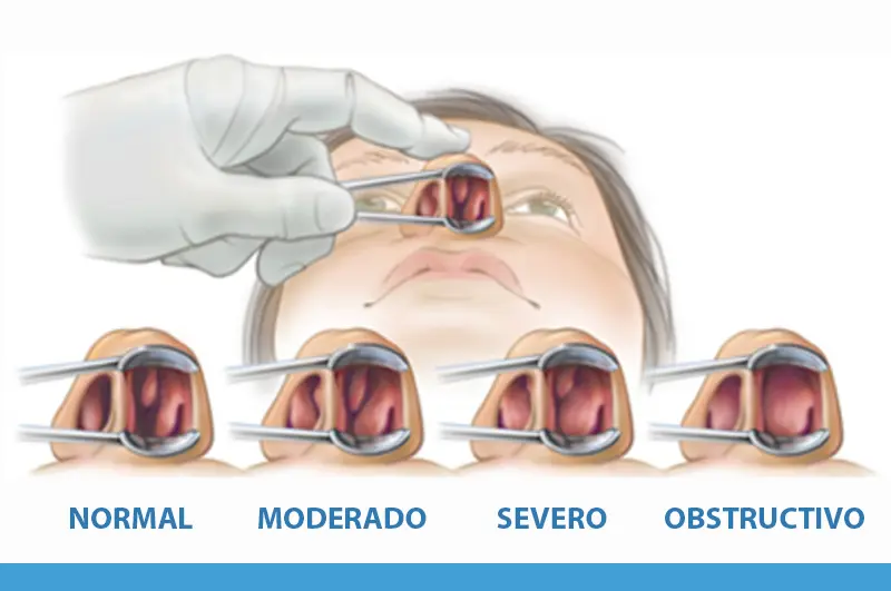 Cirugía de Tabique Desviado: Costos, Procedimiento y Beneficios - Cuánto cuesta una cirugía de tabique desviado cirugia tabique desviado - Cuánto cuesta una cirugía de tabique desviado