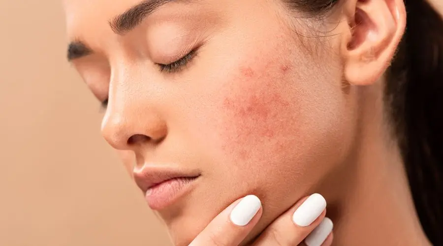<b>Clínica de Enfermedades de la Piel</b>: Todo lo que necesitas saber - Cuánto cuesta una consulta dermatológica en Argentina clinica de enfermedades de la piel - Cuánto cuesta una consulta dermatológica en Argentina