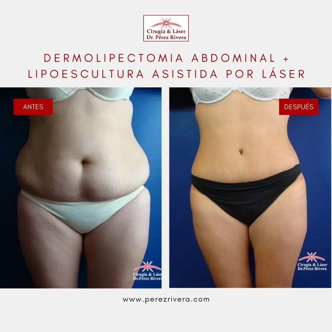 Dermolipectomía Precios: Guía Completa en Argentina - Cuánto cuesta una operación de abdominoplastia dermolipectomia precios - Cuánto cuesta una operación de abdominoplastia