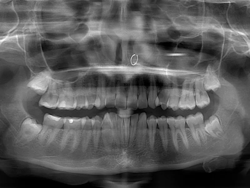 Radiografía Bucal: Costos, Tipos y Beneficios - Cuánto cuesta una radiografía de la boca radiografia bucal - Cuánto cuesta una radiografía de la boca