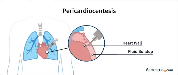 Pericardiocentesis: Procedimiento, Riesgos y Beneficios - Cuánto drenar en pericardiocentesis pericardiocentesis - Cuánto drenar en pericardiocentesis