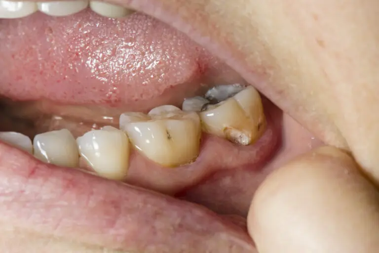 Dolor de muelas por infección: Causas, síntomas y tratamientos - Cuánto dura el dolor de muelas por infección infeccion dolor de muela - Cuánto dura el dolor de muelas por infección
