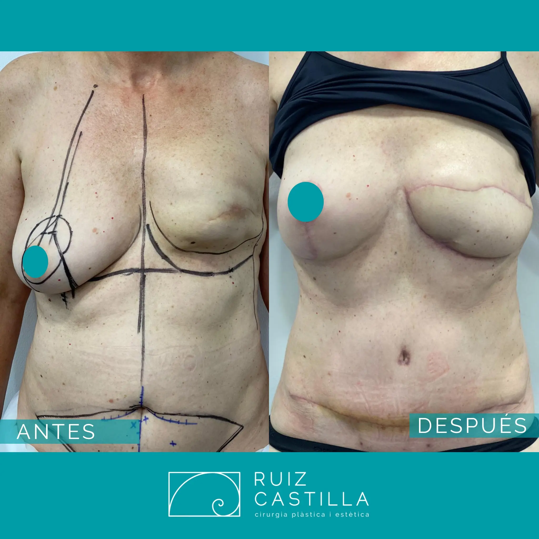 Reconstrucción de mama: Tipos de procedimientos, recuperación y riesgos - Cuánto dura la recuperación de una reconstrucción de mama reconstrucción de mama - Cuánto dura la recuperación de una reconstrucción de mama