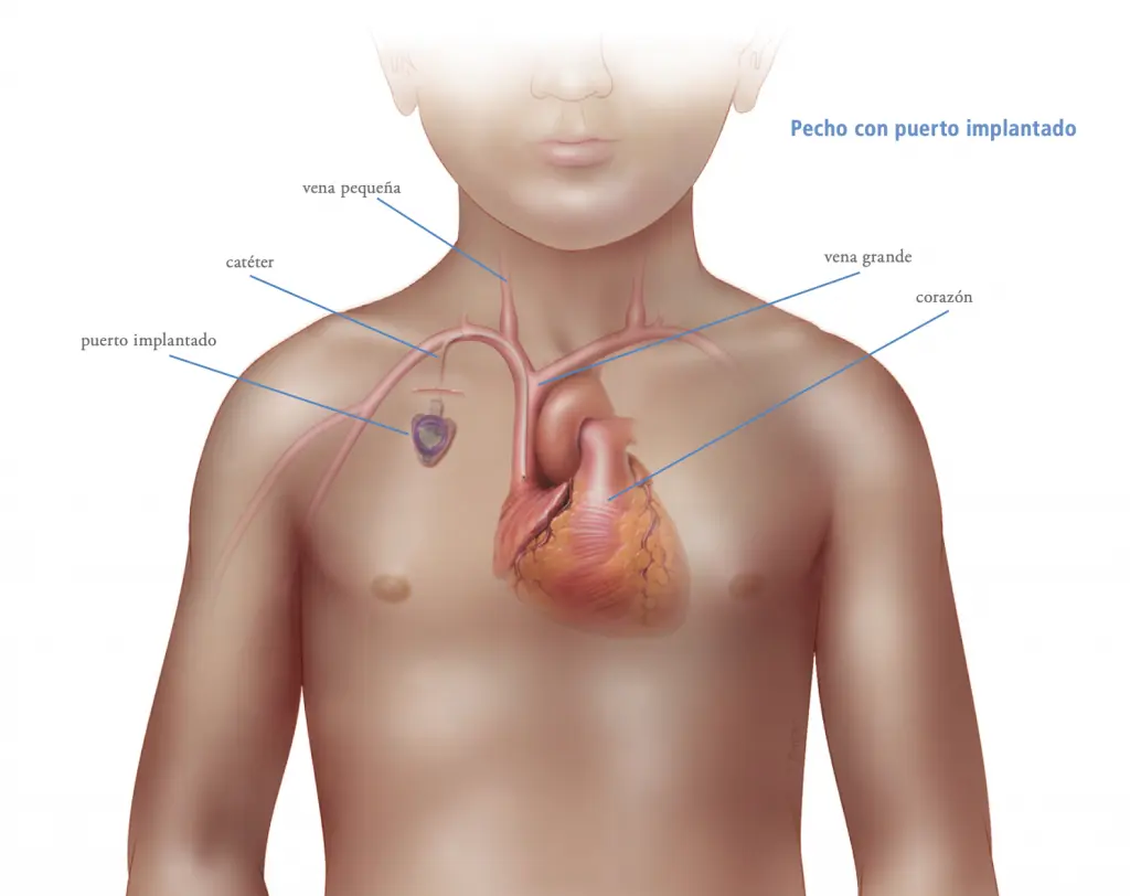 Catéter Implantable: Guía Completa para Pacientes - Cuánto dura un catéter implantable cateter implantable - Cuánto dura un catéter implantable