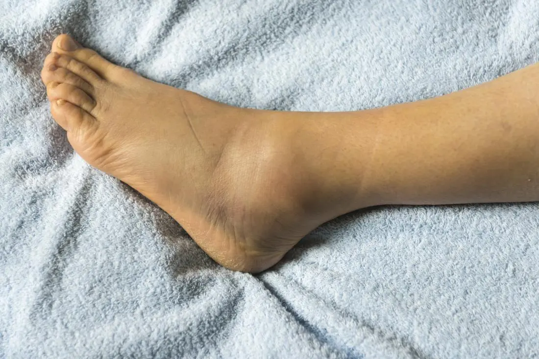Edema de Tobillo: Causas, Síntomas y Tratamiento - Cuánto dura un edema en el tobillo edema tobillo - Cuánto dura un edema en el tobillo