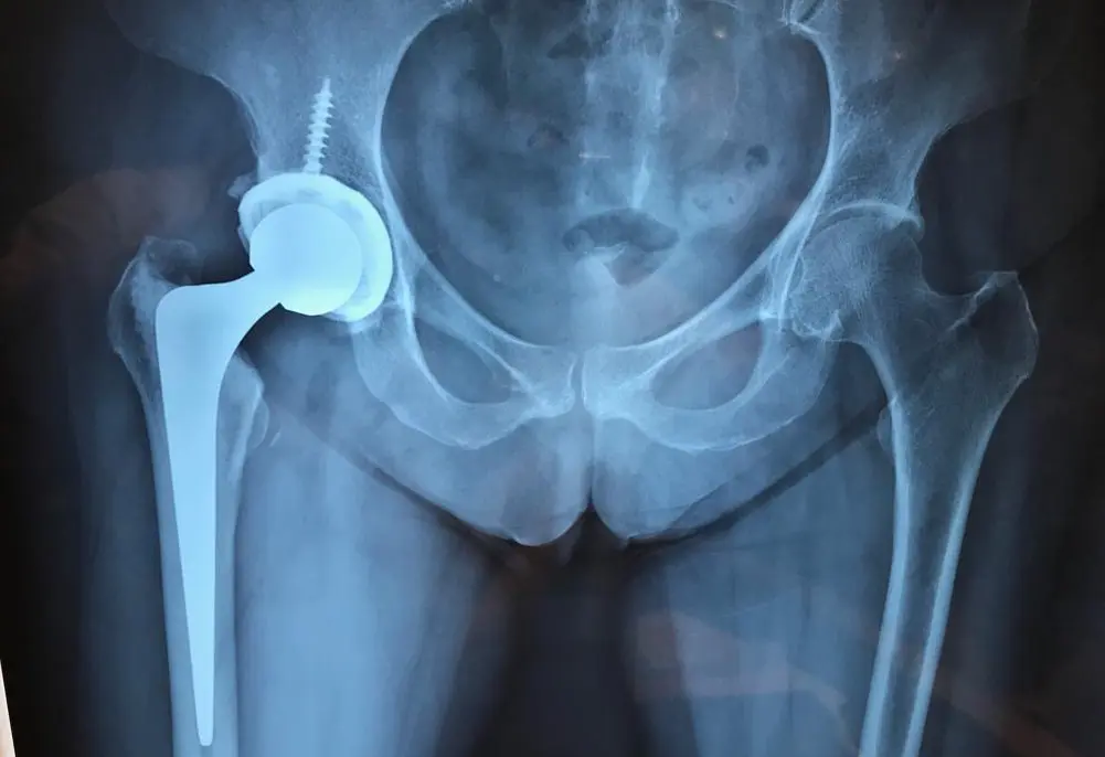 Artroplastia: Reemplazo Articular para una Vida Activa - Cuánto dura una artroplastia artroplastia - Cuánto dura una artroplastia