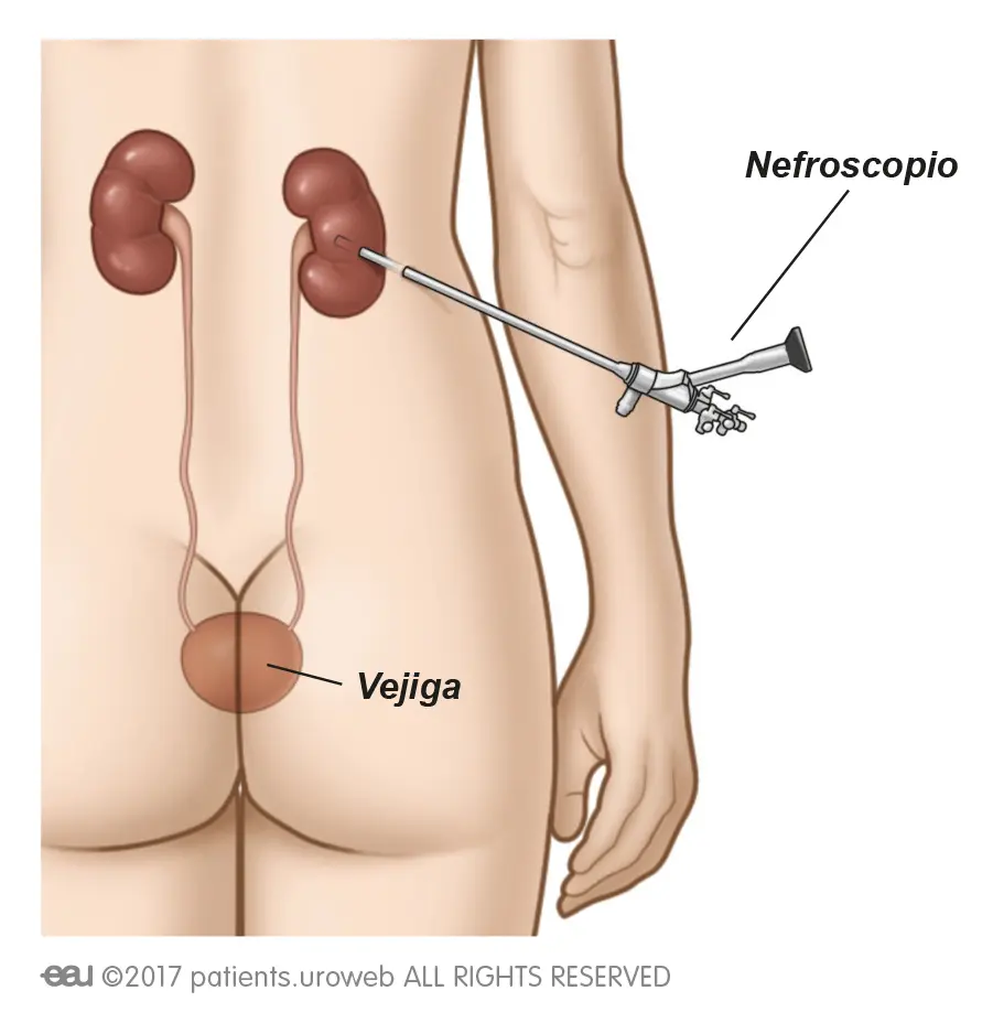 Nefrolitotomía Percutánea: Procedimiento para Extraer Cálculos Renales - Cuánto dura una cirugía percutanea de riñón nefrolitotricia percutánea - Cuánto dura una cirugía percutanea de riñón