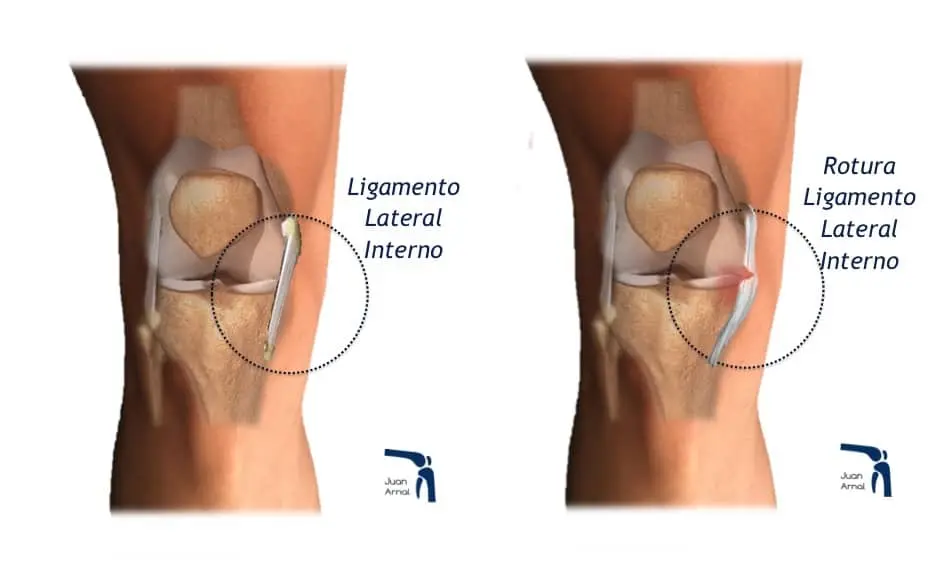 Distensión de Ligamentos de Rodilla: Causas, Síntomas y Tratamiento - Cuánto dura una distensión de ligamentos en la rodilla distensión de ligamentos rodilla - Cuánto dura una distensión de ligamentos en la rodilla