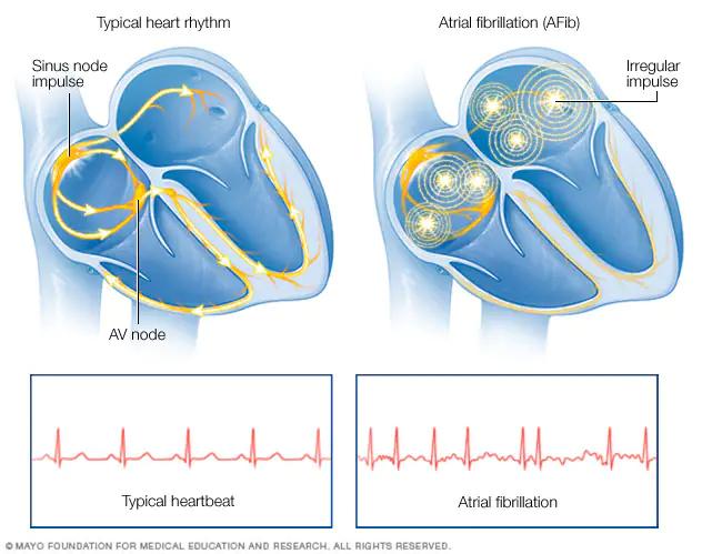 Fibrilación Auricular Paroxística: Causas, Síntomas y Tratamiento - Cuánto dura una fibrilación auricular paroxística fibrilacion auricular paroxistica - Cuánto dura una fibrilación auricular paroxística