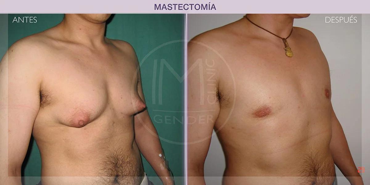 Mastectomía Bilateral: Todo lo que Debes Saber - Cuánto dura una mastectomía bilateral mastectomia bilateral - Cuánto dura una mastectomía bilateral