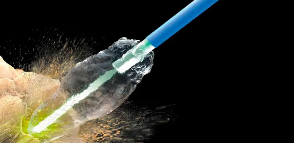 Litotricia Láser: La Solución Definitiva para los Cálculos Renales - Cuánto dura una operación de piedras en el riñón con láser litotricia laser - Cuánto dura una operación de piedras en el riñón con láser