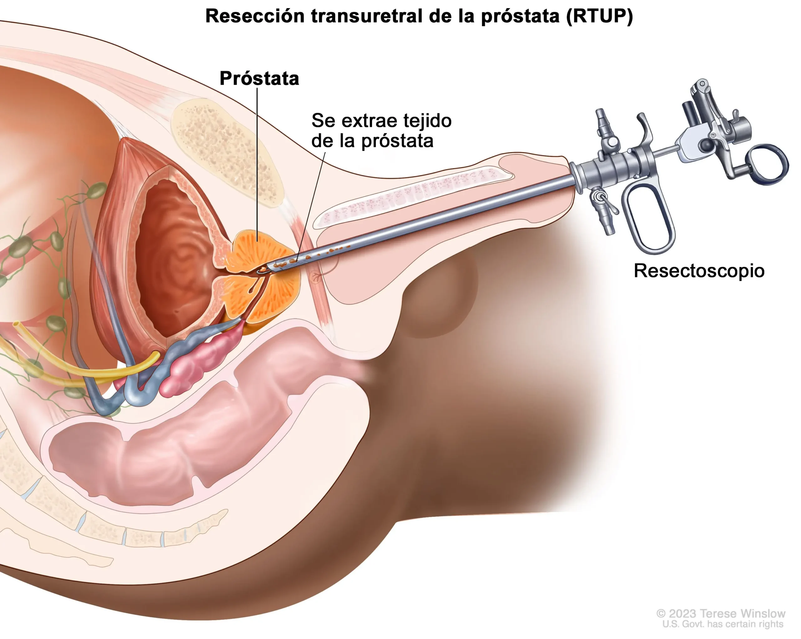 Resección Transuretral de Próstata (RTU): Procedimiento, Riesgos y Recuperación - Cuánto dura una resección transuretral reseccion transuretral de prostata - Cuánto dura una resección transuretral