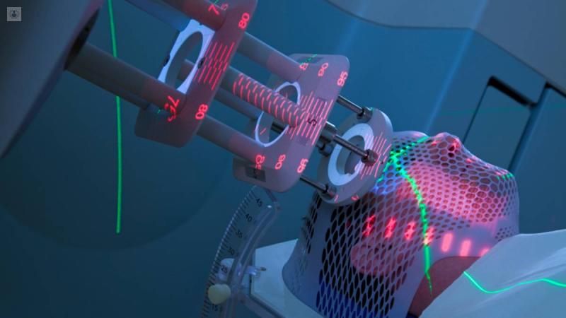 Radiocirugía: Una guía completa sobre este procedimiento - Cuánto dura una sesión de radiocirugía radiocirugia - Cuánto dura una sesión de radiocirugía