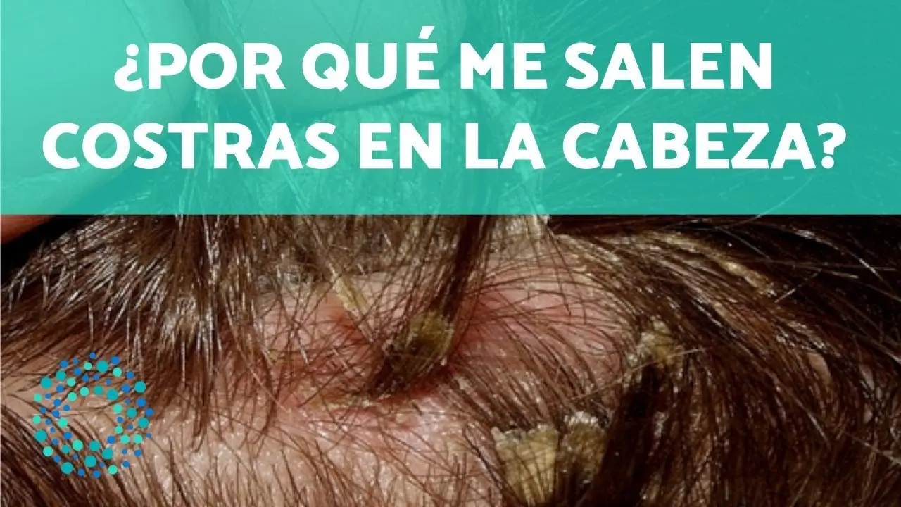Crostas en la cabeza: ¿Cuánto duran y cómo tratarlas? - Cuánto duran las costras en la cabeza costras en la cabeza - Cuánto duran las costras en la cabeza